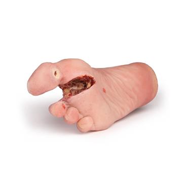 Pie lesionado con síndrome de diabetes en etapa grave