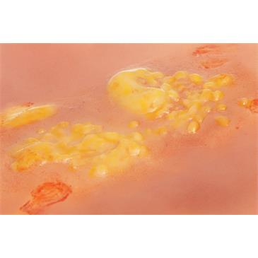 Molde de heridas por quemaduras de segundo grado