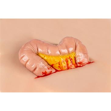 Molde “herida por protrusión del intestino grueso"