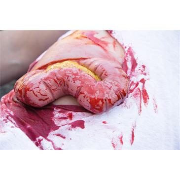 Molde “herida por protrusión del intestino grueso"