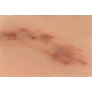Hematoma reciente
