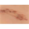 Hematoma reciente