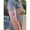 Hematoma reciente