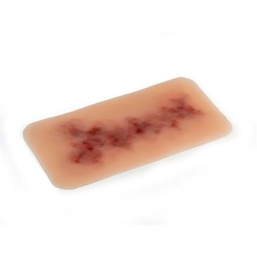 Hematoma antiguo