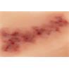 Hematoma antiguo