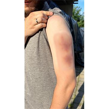 Hematoma antiguo