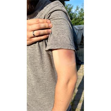 Hematoma antiguo