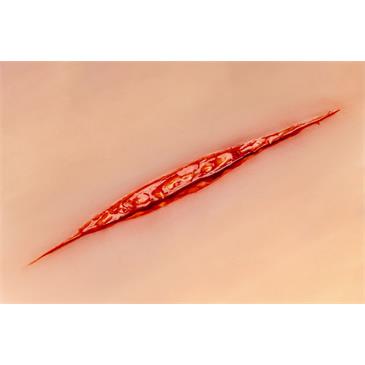 Herida antebrazo Intento de suicidio