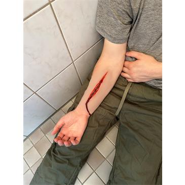 Herida antebrazo Intento de suicidio