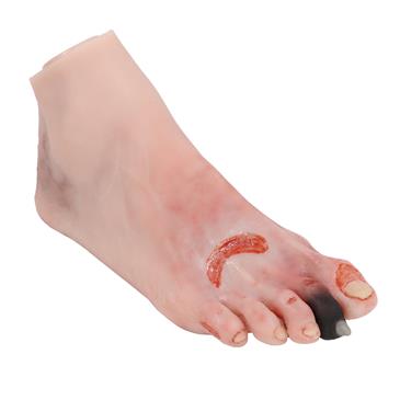 Pie herido con síndrome del pie diabético