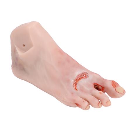 Pie herido con síndrome del pie diabético, etapa grave, versión maniquí Pie herido con síndrome del pie diabético, etapa grave, versión maniquí