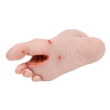 Pie herido con síndrome del pie diabético, etapa grave, versión maniquí