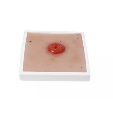Herida de colostoma, soporte incluido