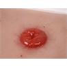 Herida de colostoma, soporte incluido