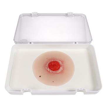Herida de colostoma inflamada, autoadhesivo