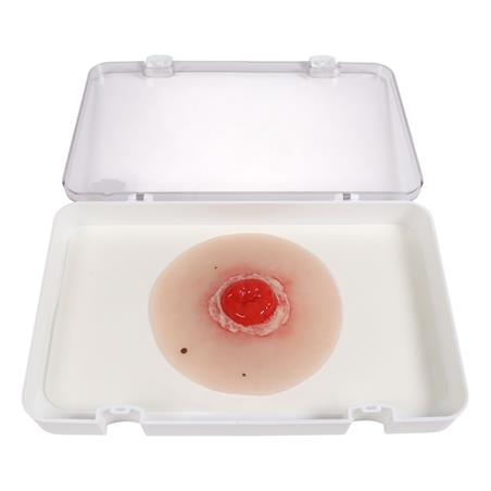 Herida de colostoma inflamada, autoadhesivo Herida de colostoma inflamada, autoadhesivo