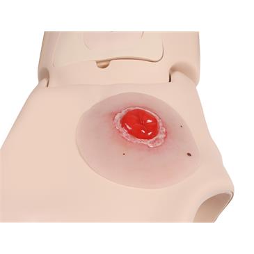 Herida de colostoma inflamada, autoadhesivo