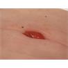 Herida de colostoma en pliegue abdominal, soporte incluido