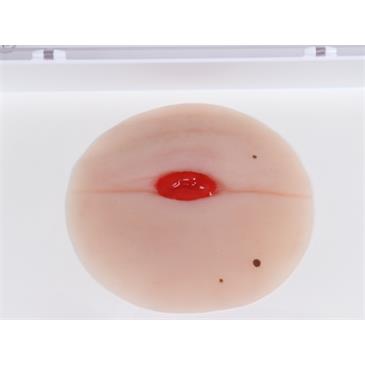 Herida de colostoma en pliegue abdominal, autoadhesiva