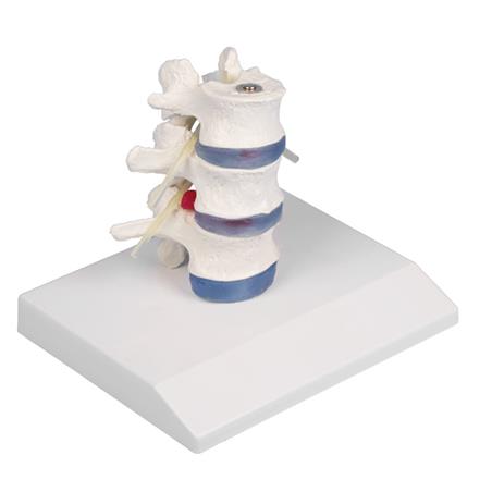 Vértebras lumbares con prolapso de discos intervertebrales con soporte Vértebras lumbares con prolapso de discos intervertebrales con soporte