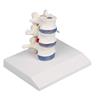 Vértebras lumbares con prolapso de discos intervertebrales con soporte