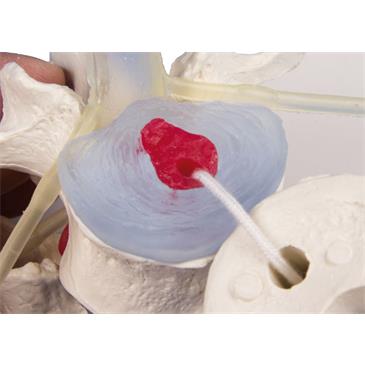 Vértebras lumbares con prolapso de discos intervertebrales con soporte