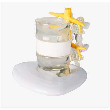 Modelo de hernia discal