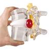 Modelo de hernia discal