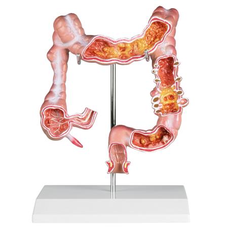 Modelo de colon con enfermedades Modelo de colon con enfermedades