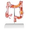 Modelo de colon con enfermedades